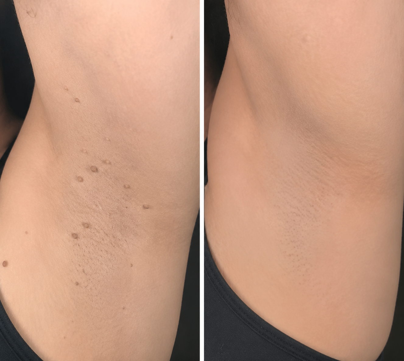 ✨LUMIVO™2-in-1 Microneedle & Hydrocolloid Patch🍀| Removes Raised Moles, Acne, Flat Warts & Skin Tags | Helps Improve Wrinkles, Scars & Blemishes | Invisible Patches for Face & Body
