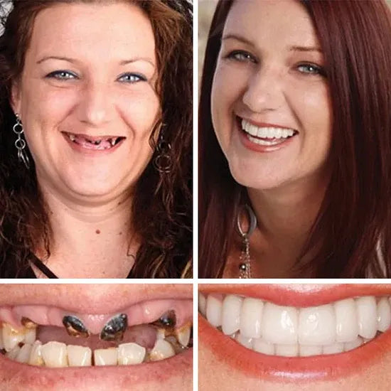 ⏰Ends Today: 70% OFF! 🌎LUMIVO™ Custom-Fit Dentures— Designed for Comfort and a Natural-Looking Smile