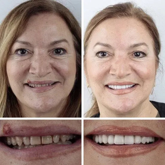 ⏰Ends Today: 70% OFF! 🌎LUMIVO™ Custom-Fit Dentures— Designed for Comfort and a Natural-Looking Smile